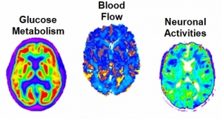 “Big Data” study discovers earliest sign of Alzheimer’s