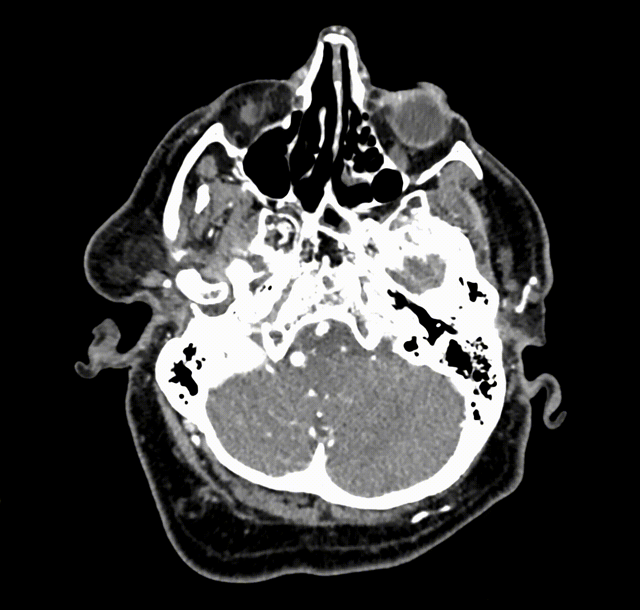 AI tool helps radiologists detect brain aneurysms