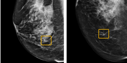 Google AI Beats Doctors at Breast Cancer Detection—Sometimes